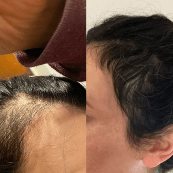 Customer scalp and hairline photos after using the Exoh red light therapy cap